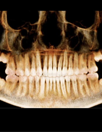 x-ray of teeth after pan
