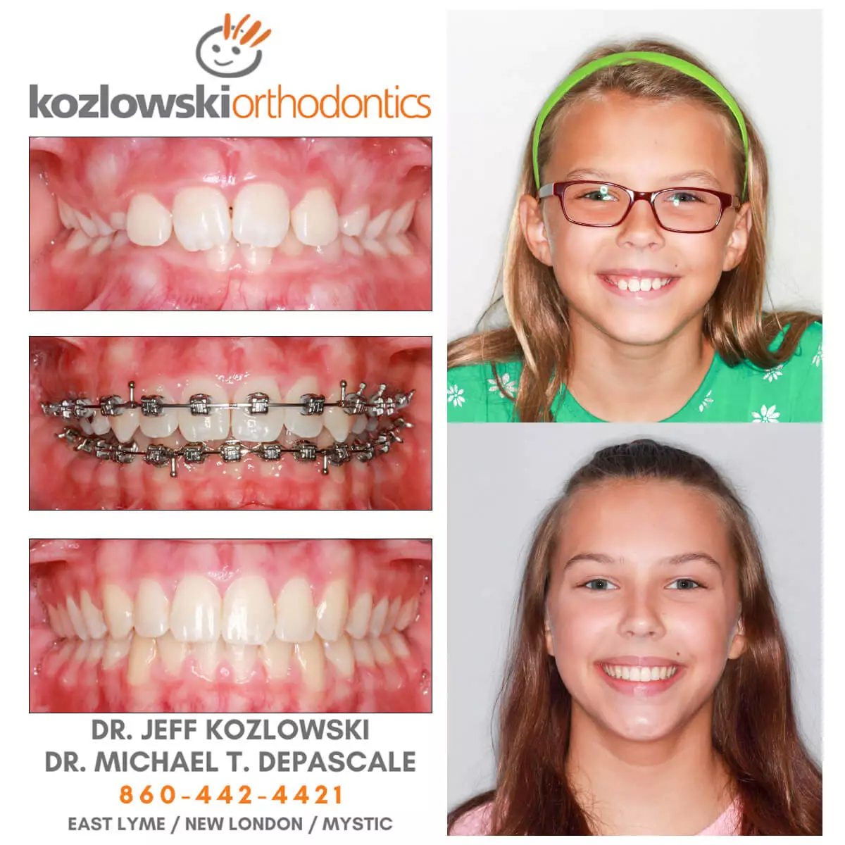 before and after images of a girl's teeth